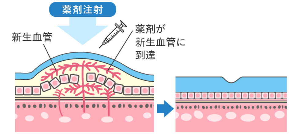 注射