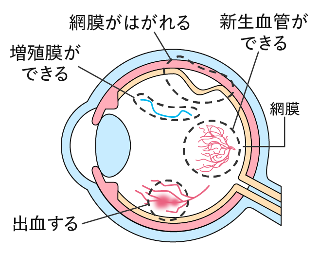 硝子体注射｜長久手さつき眼科